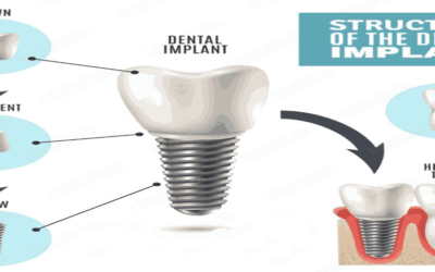 DENTAL IMPLANTS