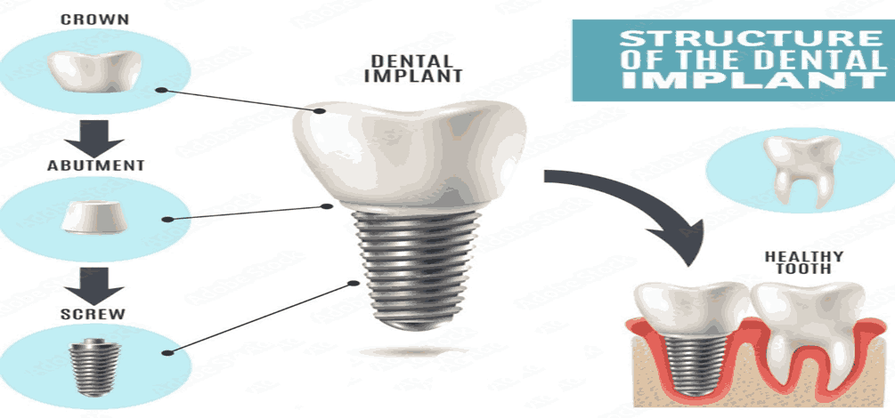 DENTAL IMPLANTS